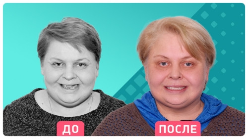 Жительница Магнитогорска восстановила зубы в Москве всего за 100 рублей. Хотите также?