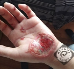 Облили руки кислотой? Жительница Магнитогорска обвинила сотрудников охранной фирмы в избиении
